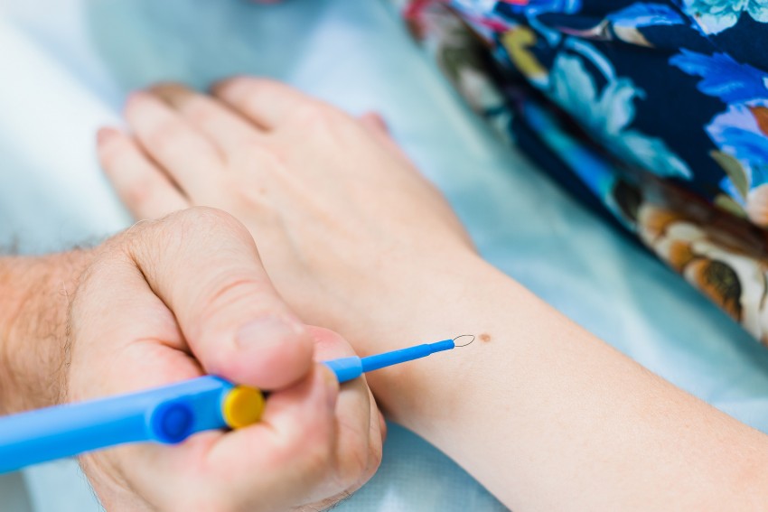 Красные родинки: виды, причины появления и советы как правильно определить что родинка опасная (110 фото)