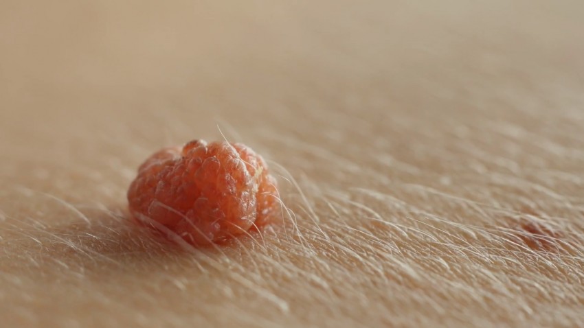 Красные родинки: виды, причины появления и советы как правильно определить что родинка опасная (110 фото)