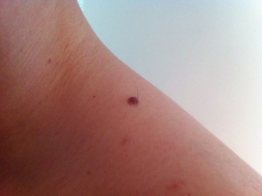 Красные родинки: виды, причины появления и советы как правильно определить что родинка опасная (110 фото)