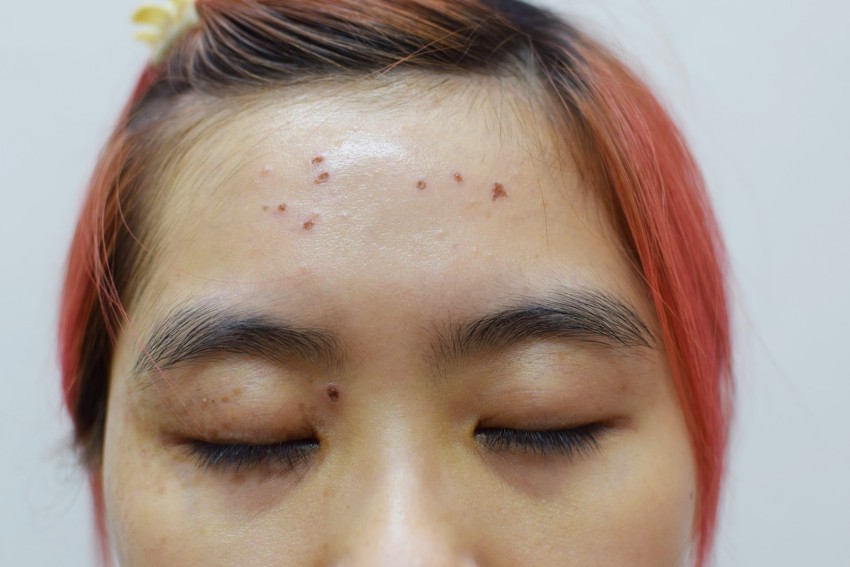 Красные родинки: виды, причины появления и советы как правильно определить что родинка опасная (110 фото)