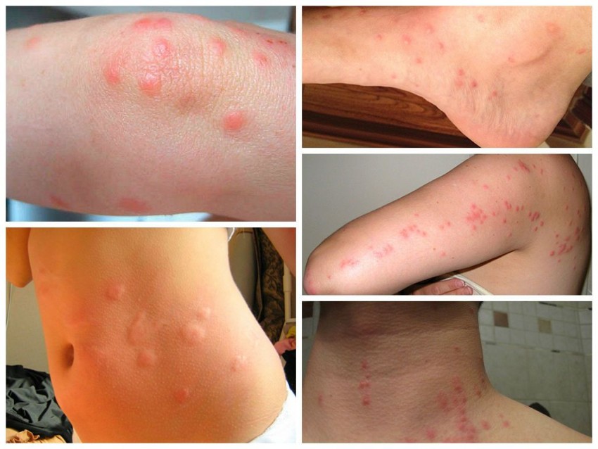 Лечение аллергии - проявления, диагностика и классификация аллергии. Советы дерматологов и аллергологов по выявлению аллергена