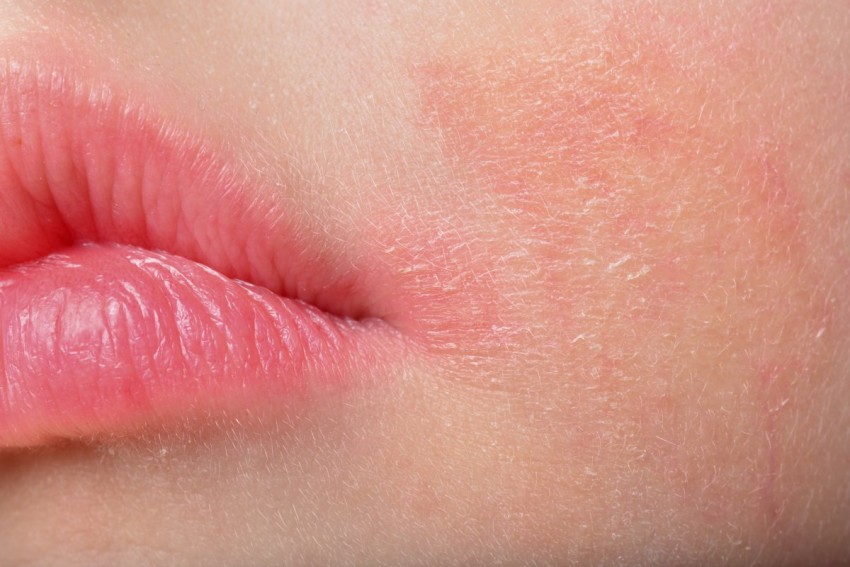 Лечение дерматита - профессиональные методы эффективного избавления от заболевания на разных участках кожи (105 фото)