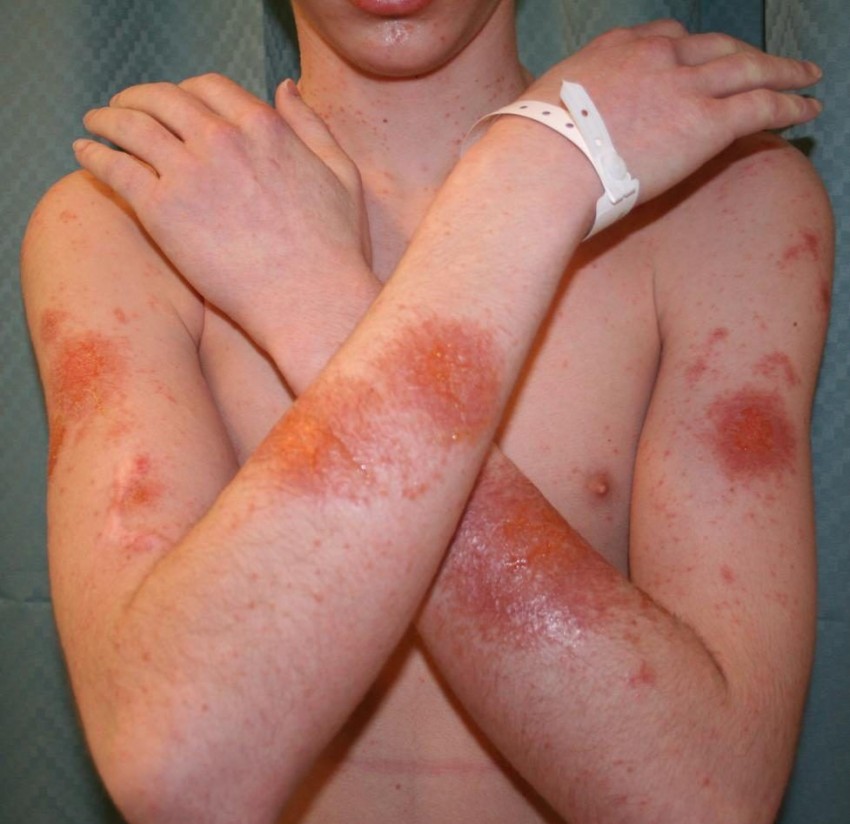 Лечение дерматита - профессиональные методы эффективного избавления от заболевания на разных участках кожи (105 фото)