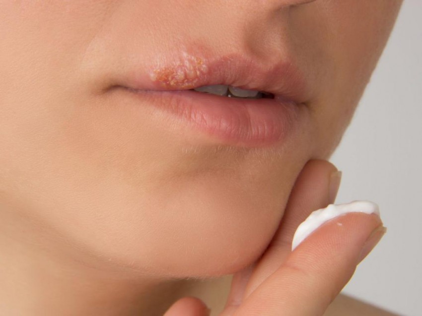 Лечение герпеса - виды и симптомы вирусного заболевания, методы лечения и причины появления болезни (100 фото и видео)