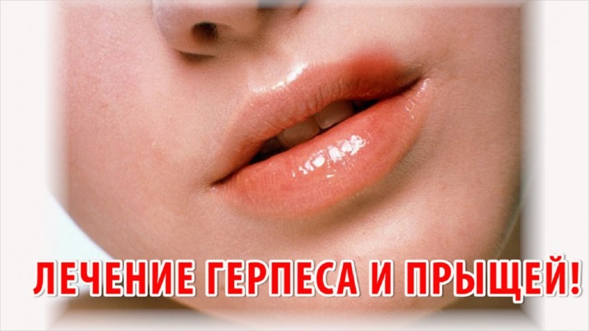 Лечение герпеса - виды и симптомы вирусного заболевания, методы лечения и причины появления болезни (100 фото и видео)