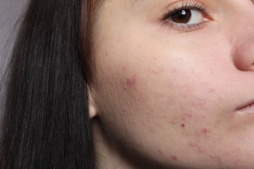 Лечение прыщей - лучшие средства и рекомендации врачей как избавиться от изъянов кожи. Лучшие средства и методики устранения угрей и сыпи (125 фото)