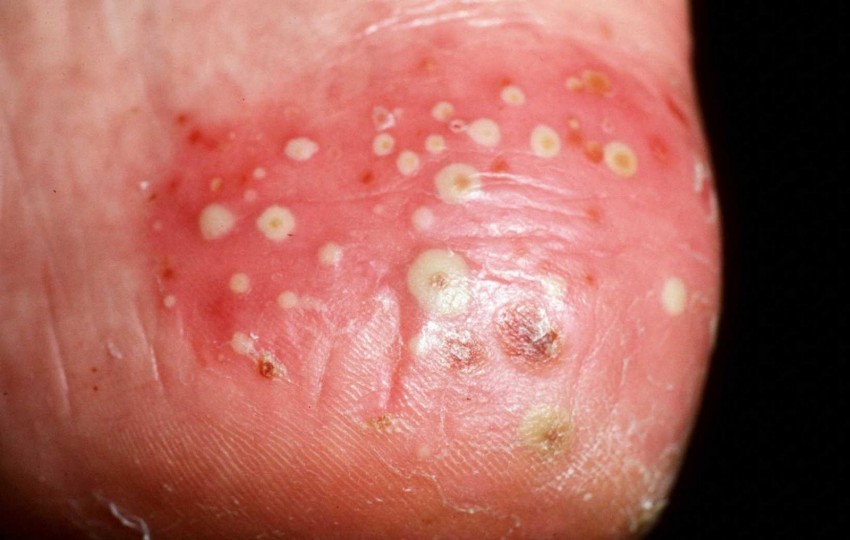 Лечение псориаза: комплексные методы лечения и восстановления кожи. Советы экспертов по выбору средств и плана лечения (125 фото)