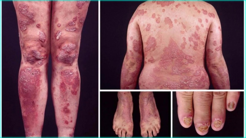 Лечение псориаза: комплексные методы лечения и восстановления кожи. Советы экспертов по выбору средств и плана лечения (125 фото)