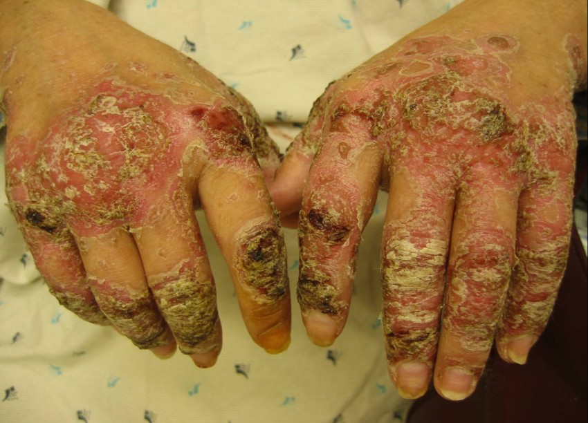 Лечение псориаза: комплексные методы лечения и восстановления кожи. Советы экспертов по выбору средств и плана лечения (125 фото)