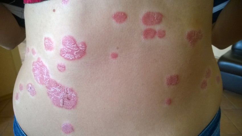 Лечение псориаза: комплексные методы лечения и восстановления кожи. Советы экспертов по выбору средств и плана лечения (125 фото)