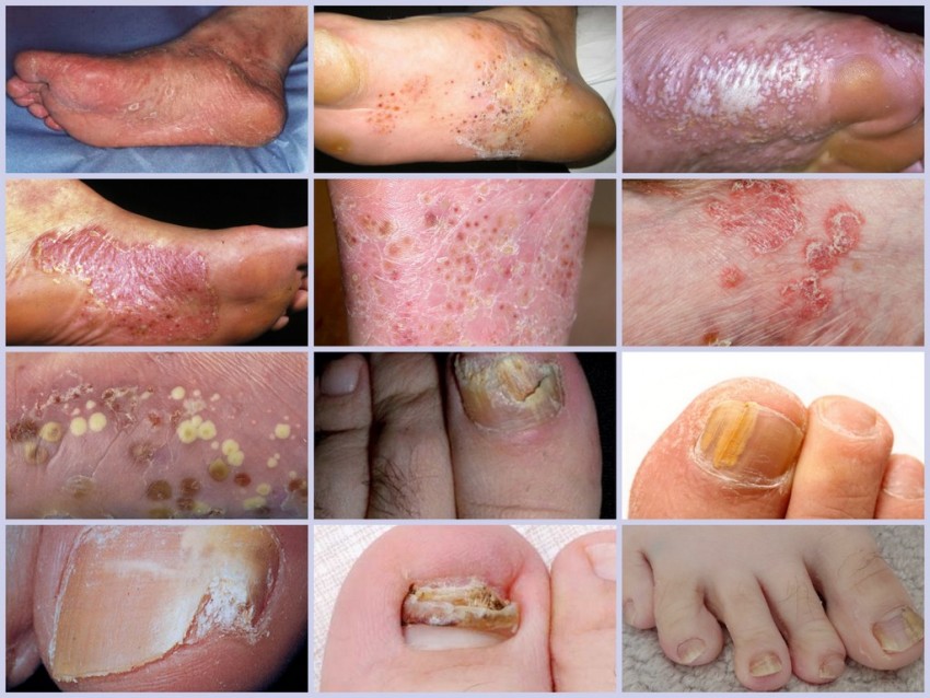 Лечить грибок на ногах в домашних условиях - эффективные и быстрые методы избавления от грибка. Советы специалистов и обзор проверенных способов лечения (115 фото)