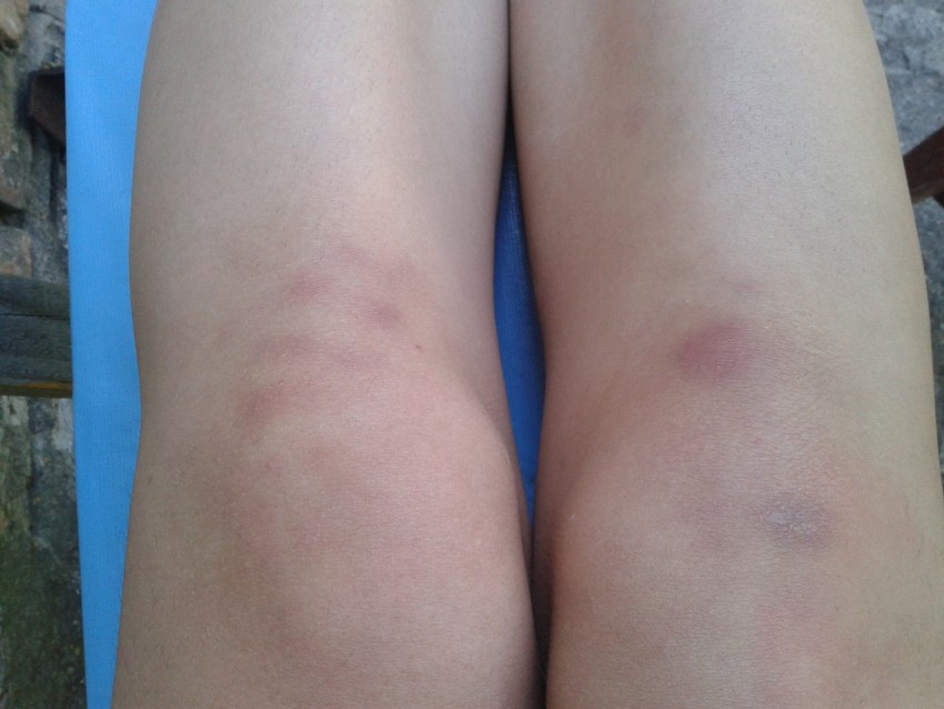 Лишай на ноге - 125 фото как выглядит лишай, распространенные места поражения и видео советы по выбору метода лечения