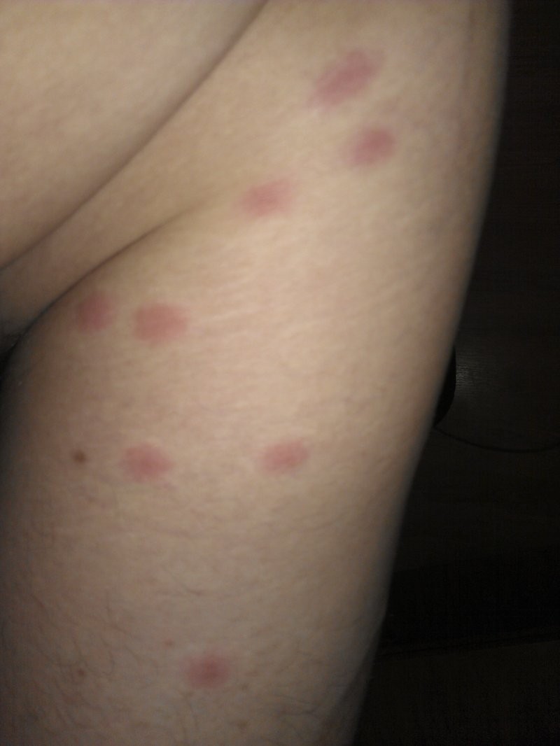 Лишай на ноге - 125 фото как выглядит лишай, распространенные места поражения и видео советы по выбору метода лечения