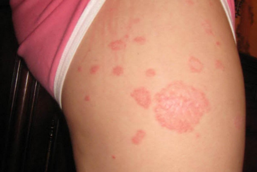 Лишай на ноге - 125 фото как выглядит лишай, распространенные места поражения и видео советы по выбору метода лечения