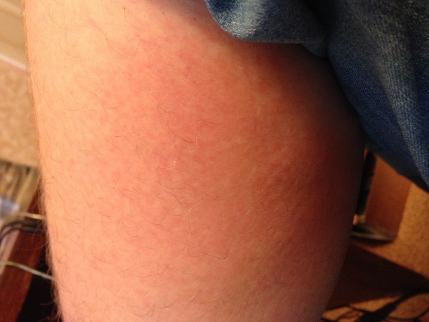 Лишай на ноге - 125 фото как выглядит лишай, распространенные места поражения и видео советы по выбору метода лечения