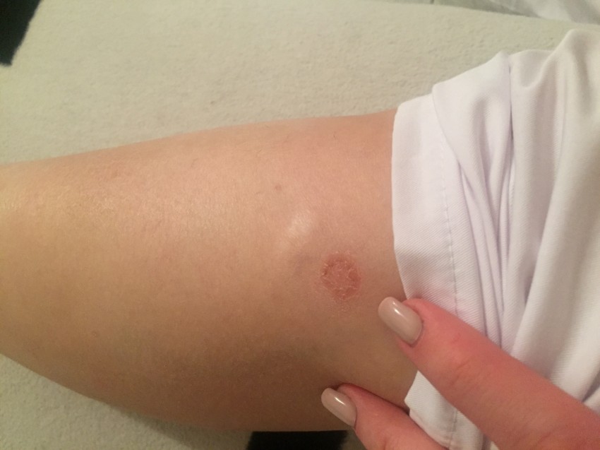 Лишай на ноге - 125 фото как выглядит лишай, распространенные места поражения и видео советы по выбору метода лечения