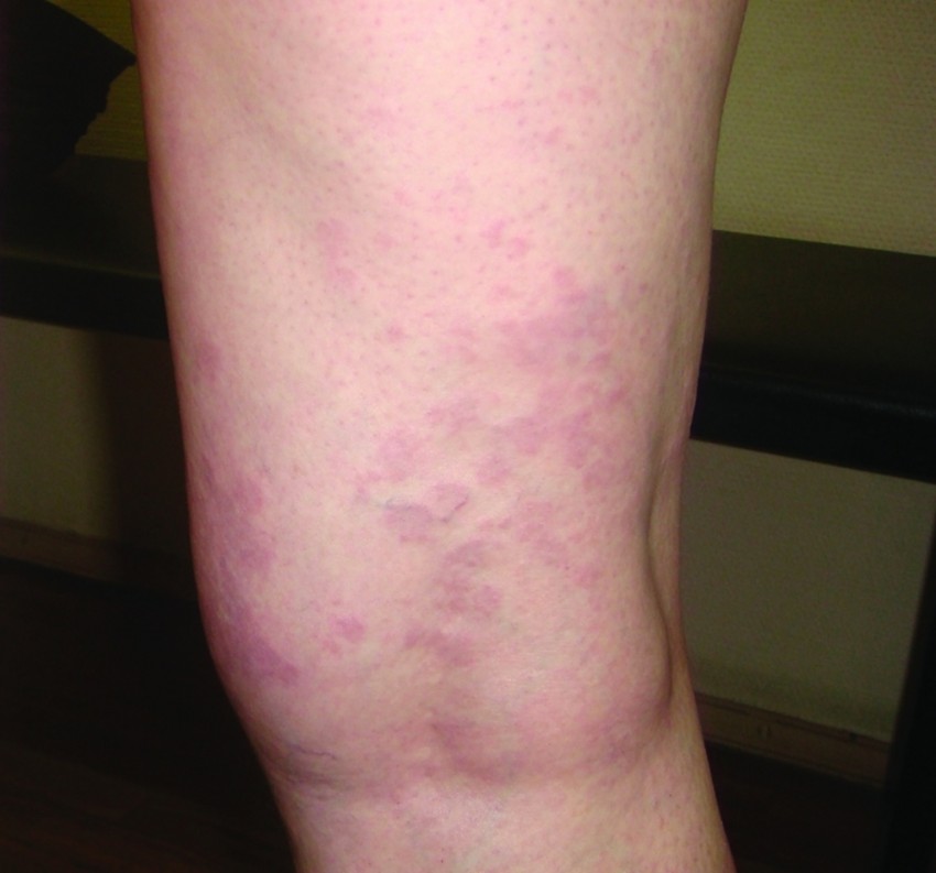 Лишай на ноге - 125 фото как выглядит лишай, распространенные места поражения и видео советы по выбору метода лечения