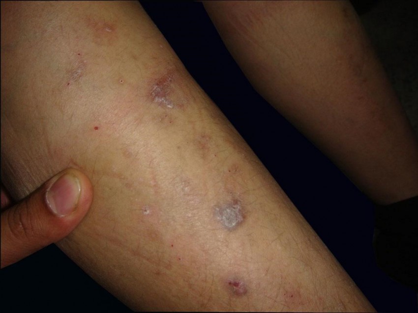 Лишай на ноге - 125 фото как выглядит лишай, распространенные места поражения и видео советы по выбору метода лечения