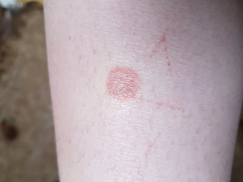 Лишай на руке - 115 фото как выглядит лишай и видео рекомендации дерматологов по лечению болезни