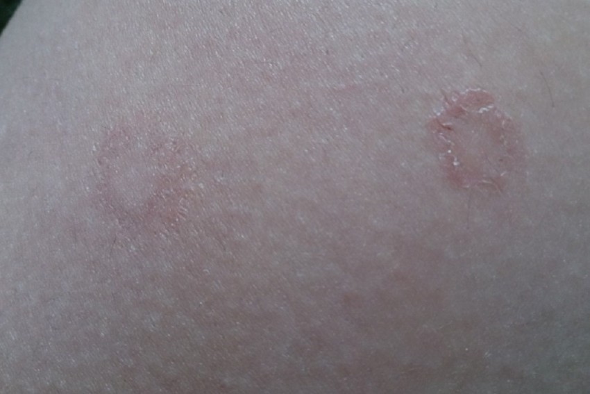 Лишай на руке - 115 фото как выглядит лишай и видео рекомендации дерматологов по лечению болезни