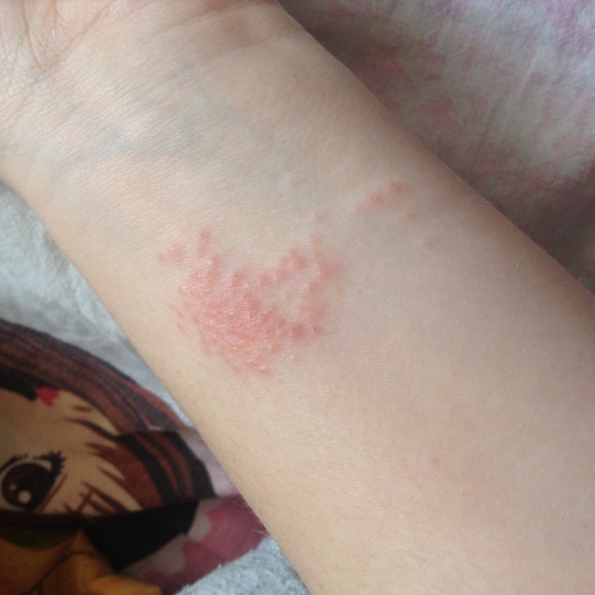 Лишай на руке - 115 фото как выглядит лишай и видео рекомендации дерматологов по лечению болезни