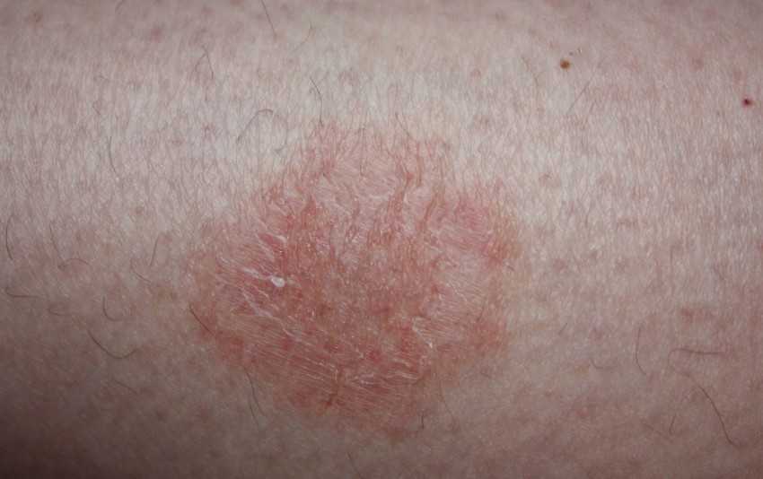 Лишай на руке - 115 фото как выглядит лишай и видео рекомендации дерматологов по лечению болезни