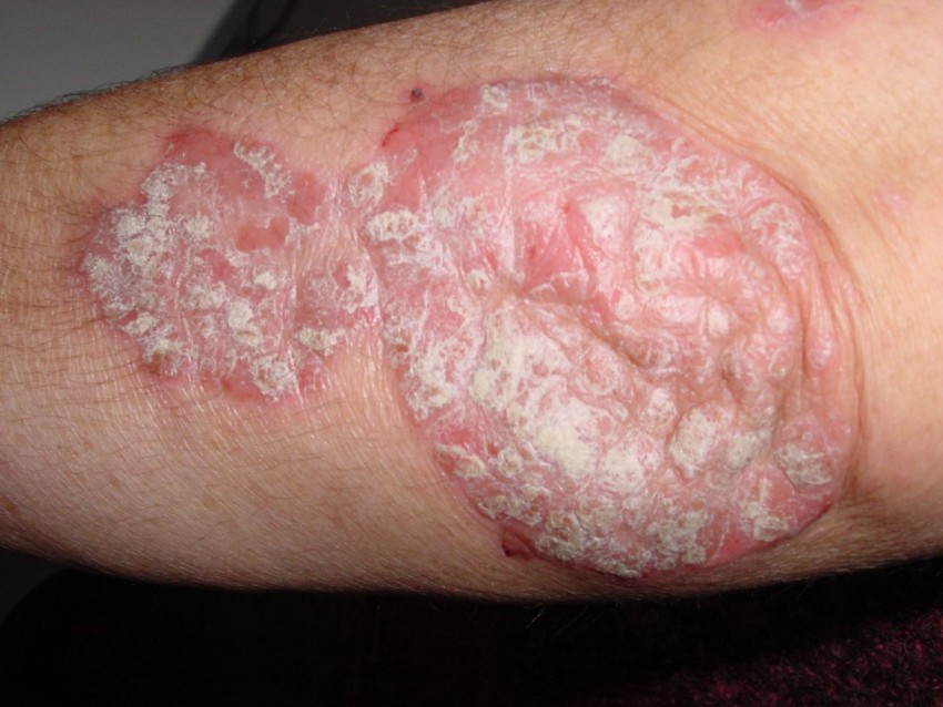 Лишай у человека - разновидности, симптомы и описание заболевания. Признаки, распространение и лечение (105 фото)