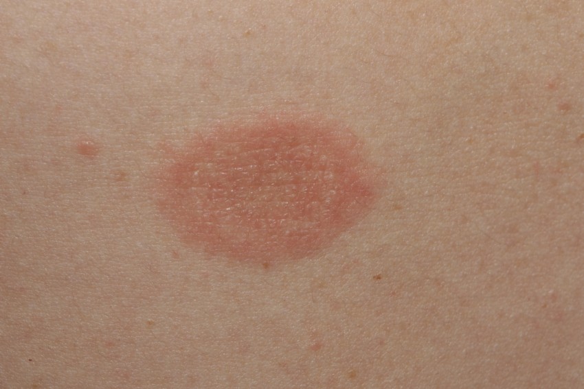 Лишай у человека - разновидности, симптомы и описание заболевания. Признаки, распространение и лечение (105 фото)