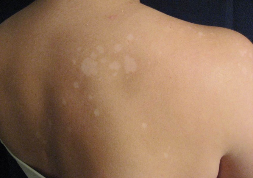 Лишай у человека - разновидности, симптомы и описание заболевания. Признаки, распространение и лечение (105 фото)