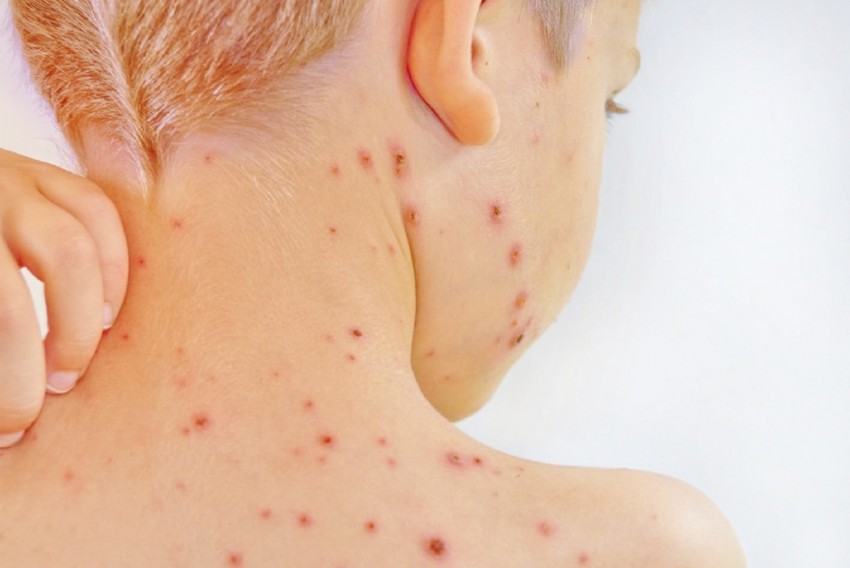 Лишай у ребенка: признаки, виды, лечение, симптомы и 95 фото как выглядит детский лишай