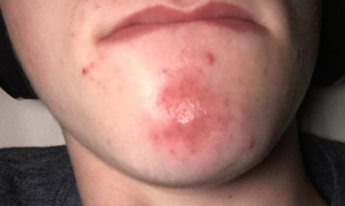 Лосьон от прыщей - советы дерматологов и обзор ТОП-5 лучших препаратов для избавления от прыщей на лице и теле (130 фото и видео)