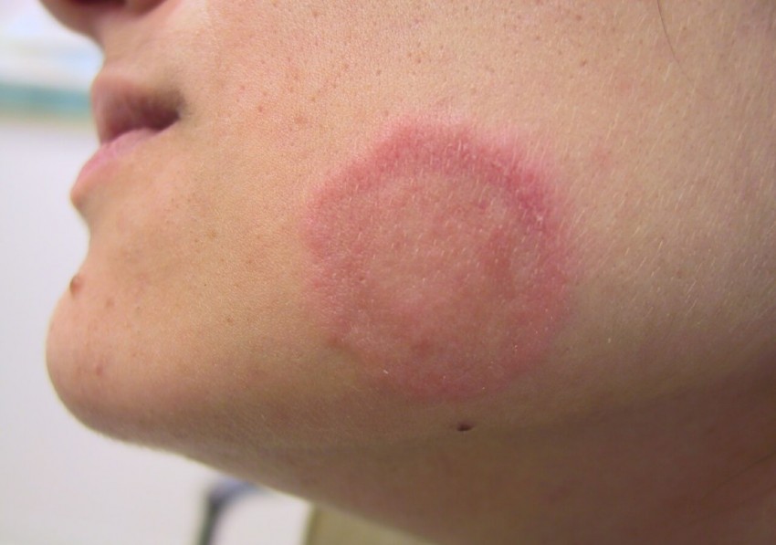 Мазь от грибка: советы по выбору эффективных противогрибковых средств и лекарств (105 фото)