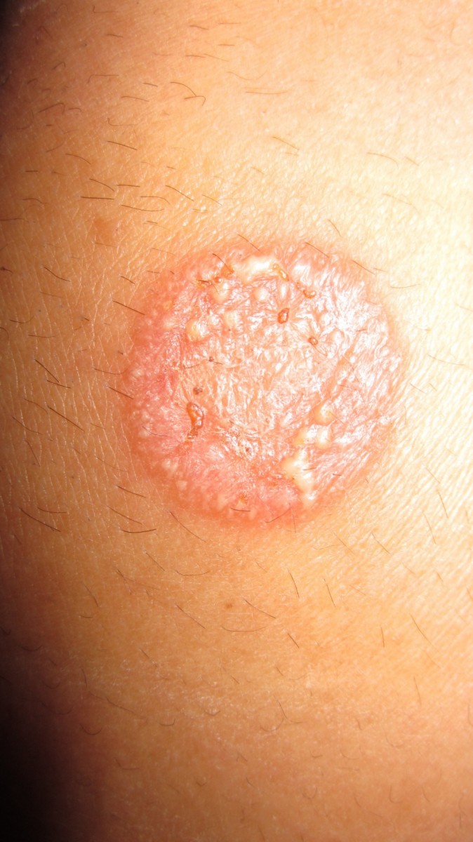 Мазь от грибка: советы по выбору эффективных противогрибковых средств и лекарств (105 фото)