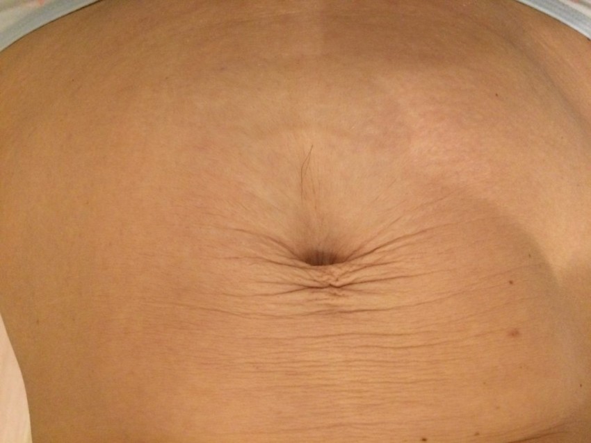 Мезотерапия тела - что это такое, зоны применения и советы косметологов по назначению процедуры (110 фото)