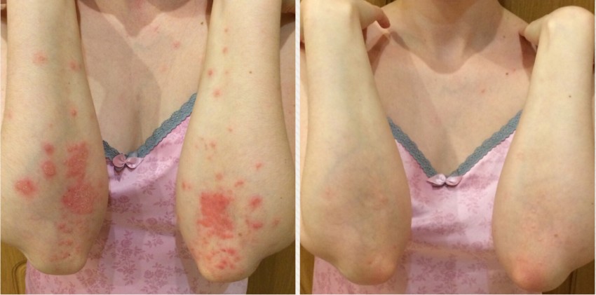 Начальная стадия псориаза: симптомы возникновения заболевания, методы купирования распространения болезни и варианты лечения (130 фото)