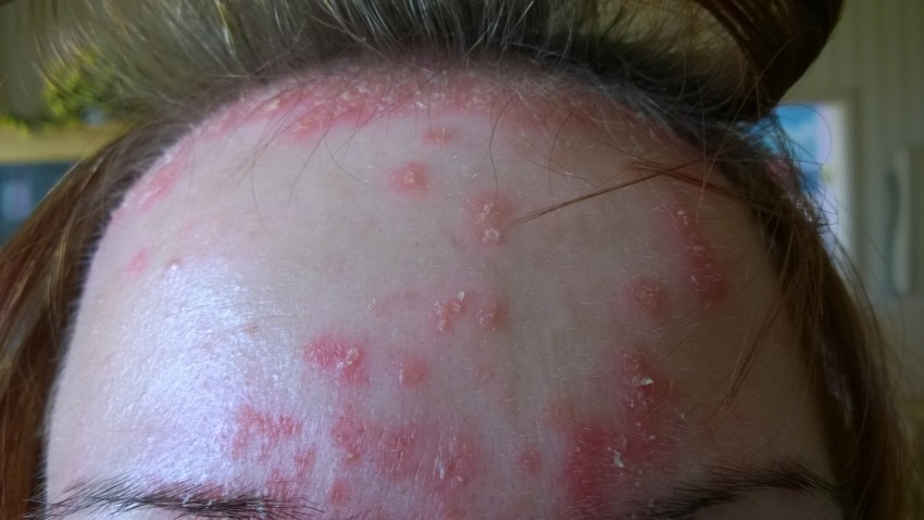 Начальная стадия псориаза: симптомы возникновения заболевания, методы купирования распространения болезни и варианты лечения (130 фото)