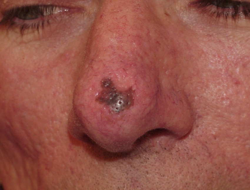 Опасные родинки - типы, проверка онколога и советы по обследованию родинок. 125 фото родинок, которые считаются врачами опасными