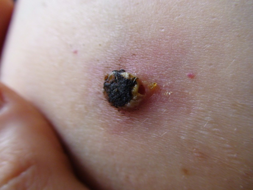 Опасные родинки - типы, проверка онколога и советы по обследованию родинок. 125 фото родинок, которые считаются врачами опасными