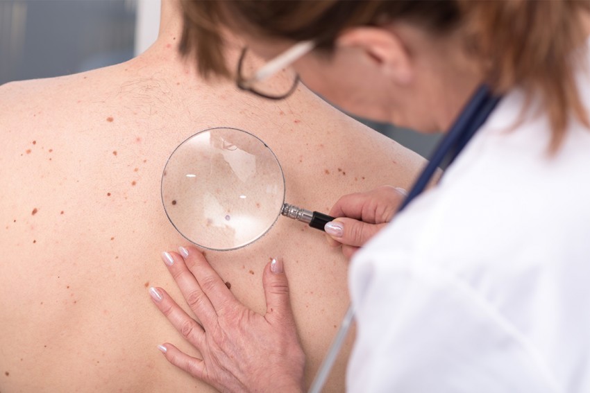 Опасные родинки - типы, проверка онколога и советы по обследованию родинок. 125 фото родинок, которые считаются врачами опасными