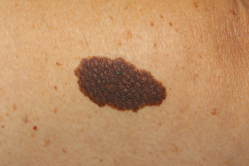 Опасные родинки - типы, проверка онколога и советы по обследованию родинок. 125 фото родинок, которые считаются врачами опасными
