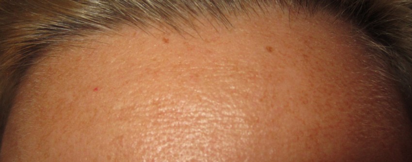 Опасные родинки - типы, проверка онколога и советы по обследованию родинок. 125 фото родинок, которые считаются врачами опасными