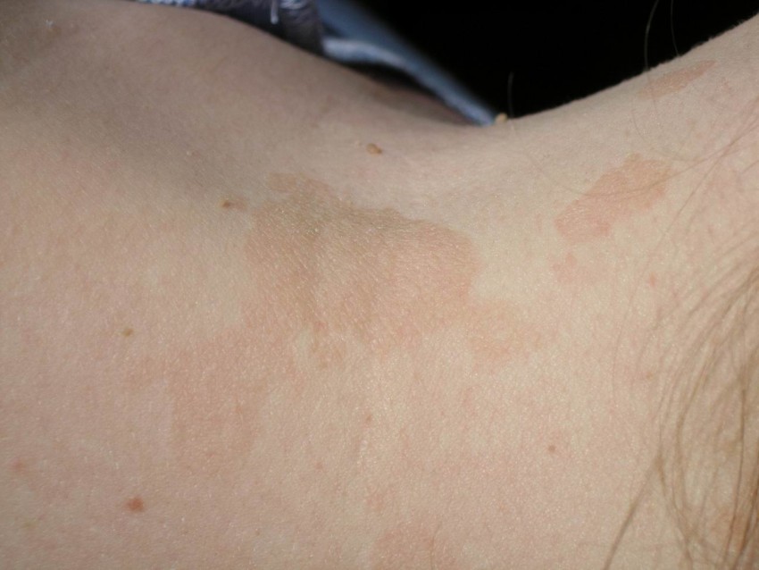 Отрубевидный лишай - симптомы, причины появления, диагностика и препараты для лечения и восстановления кожи (100 фото и видео)