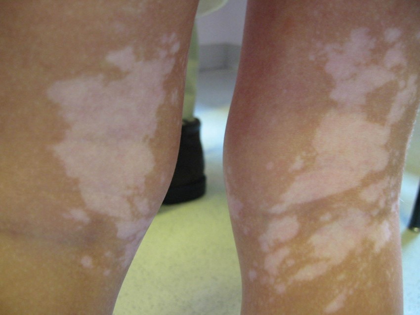 Отрубевидный лишай - симптомы, причины появления, диагностика и препараты для лечения и восстановления кожи (100 фото и видео)