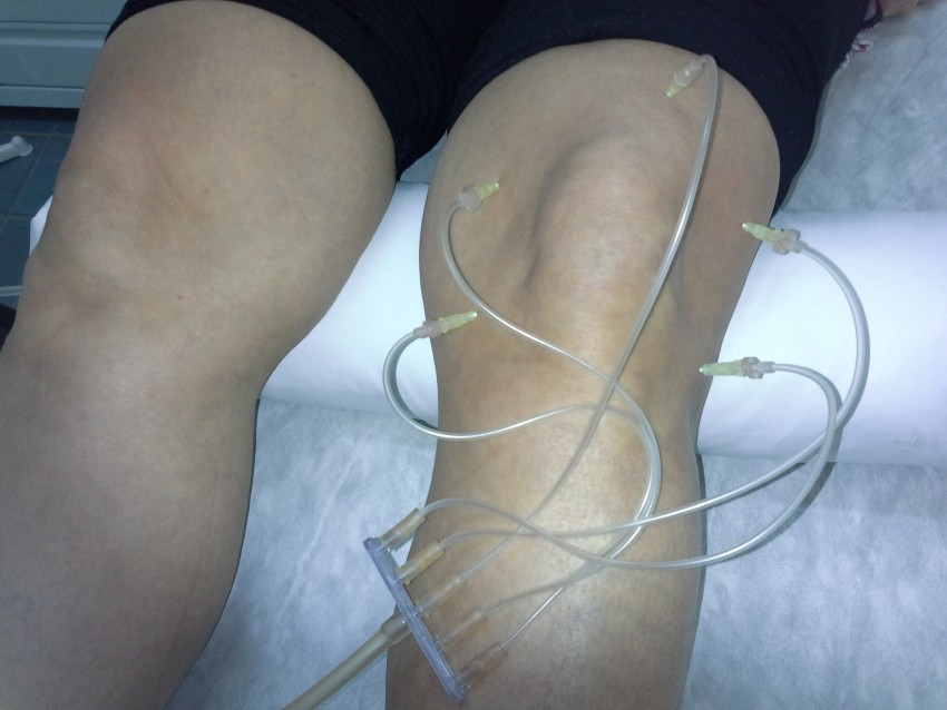 Озонотерапия - что это за процедура и показания к назначению в косметологии (115 фото + видео)