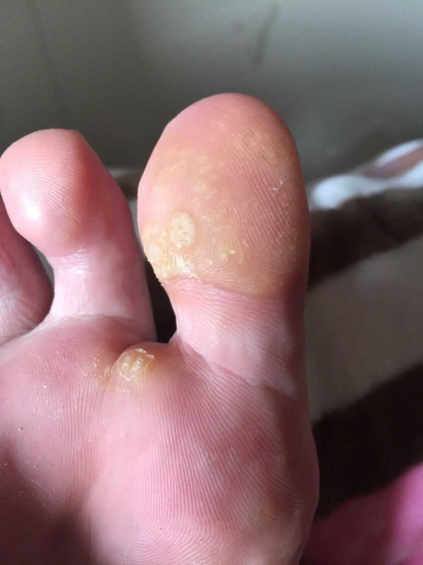 Папилайт от бородавок: состав, инструкция по применению, отзывы, цена и эффективность средства (75 фото)