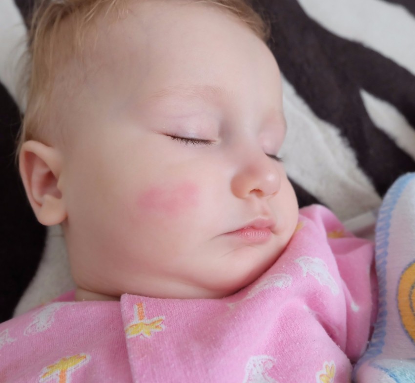 Плоский лишай - первые симптомы, причины появления, сведения о болезни и эффективное лечение (100 фото)