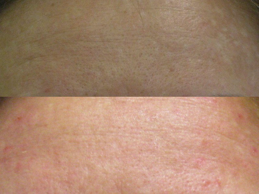 Плоский лишай - первые симптомы, причины появления, сведения о болезни и эффективное лечение (100 фото)