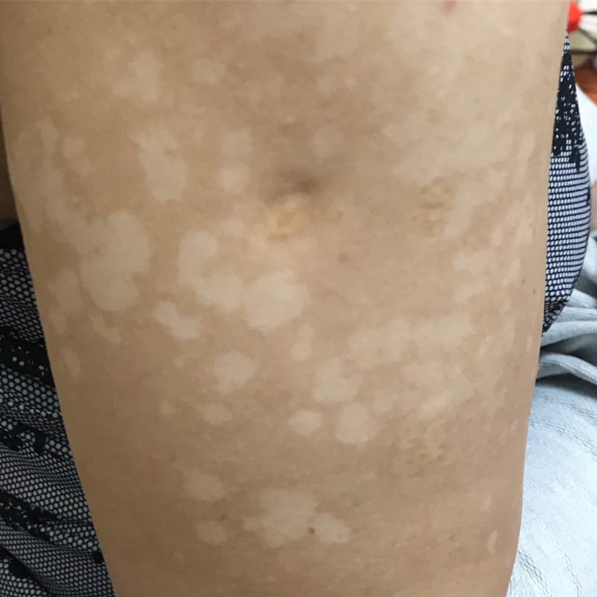 Плоский лишай - первые симптомы, причины появления, сведения о болезни и эффективное лечение (100 фото)