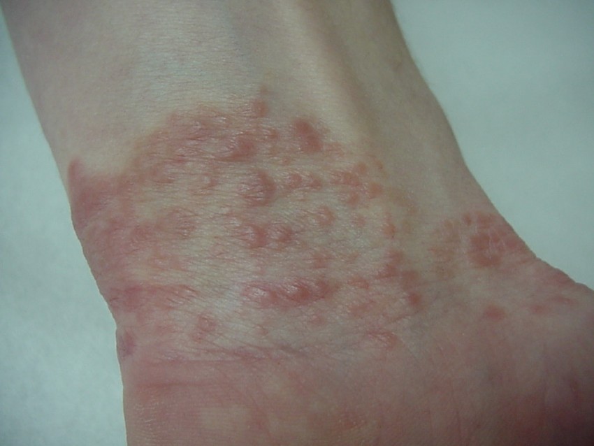 Плоский лишай - первые симптомы, причины появления, сведения о болезни и эффективное лечение (100 фото)