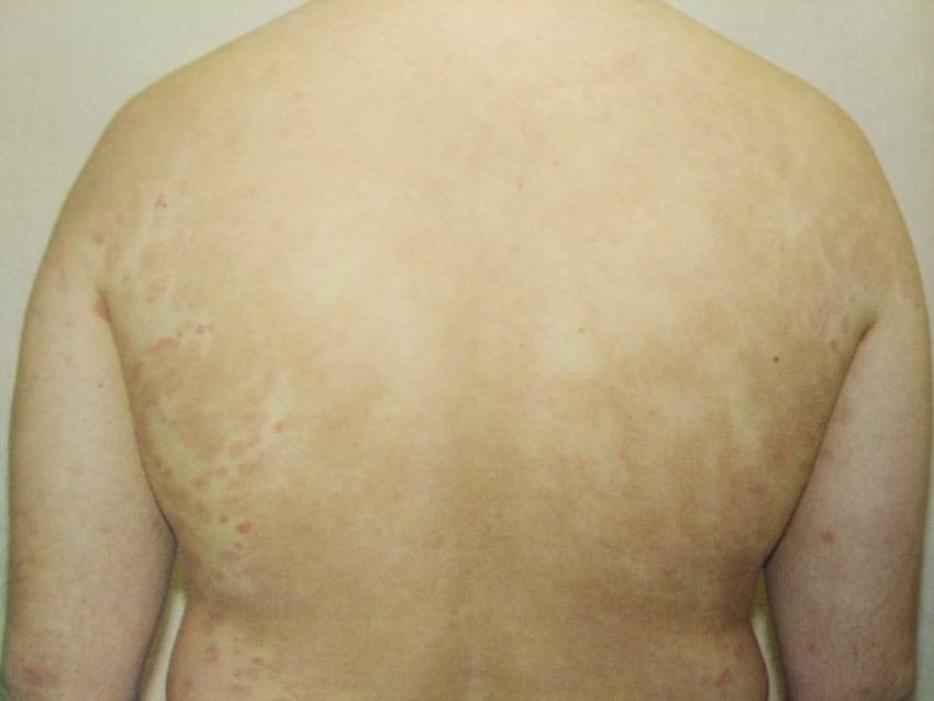 Плоский лишай - первые симптомы, причины появления, сведения о болезни и эффективное лечение (100 фото)